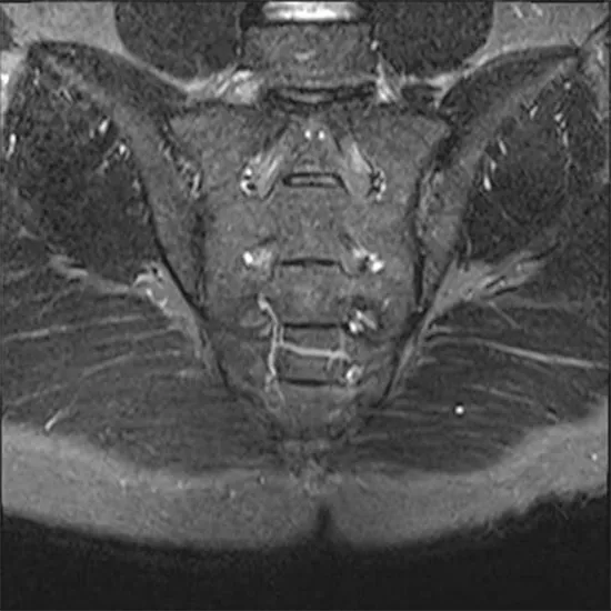 MRI Bilateral Sacroiliac (SI) Joints Test